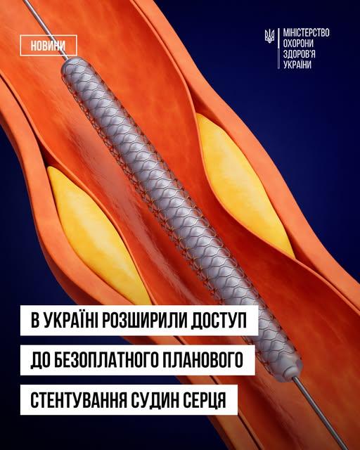Чотири лікарні Прикарпаття безкоштовно стентуватимуть судини серця